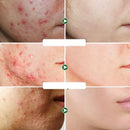 Creme Herbal para Remoção de Acne | JoyPretty
